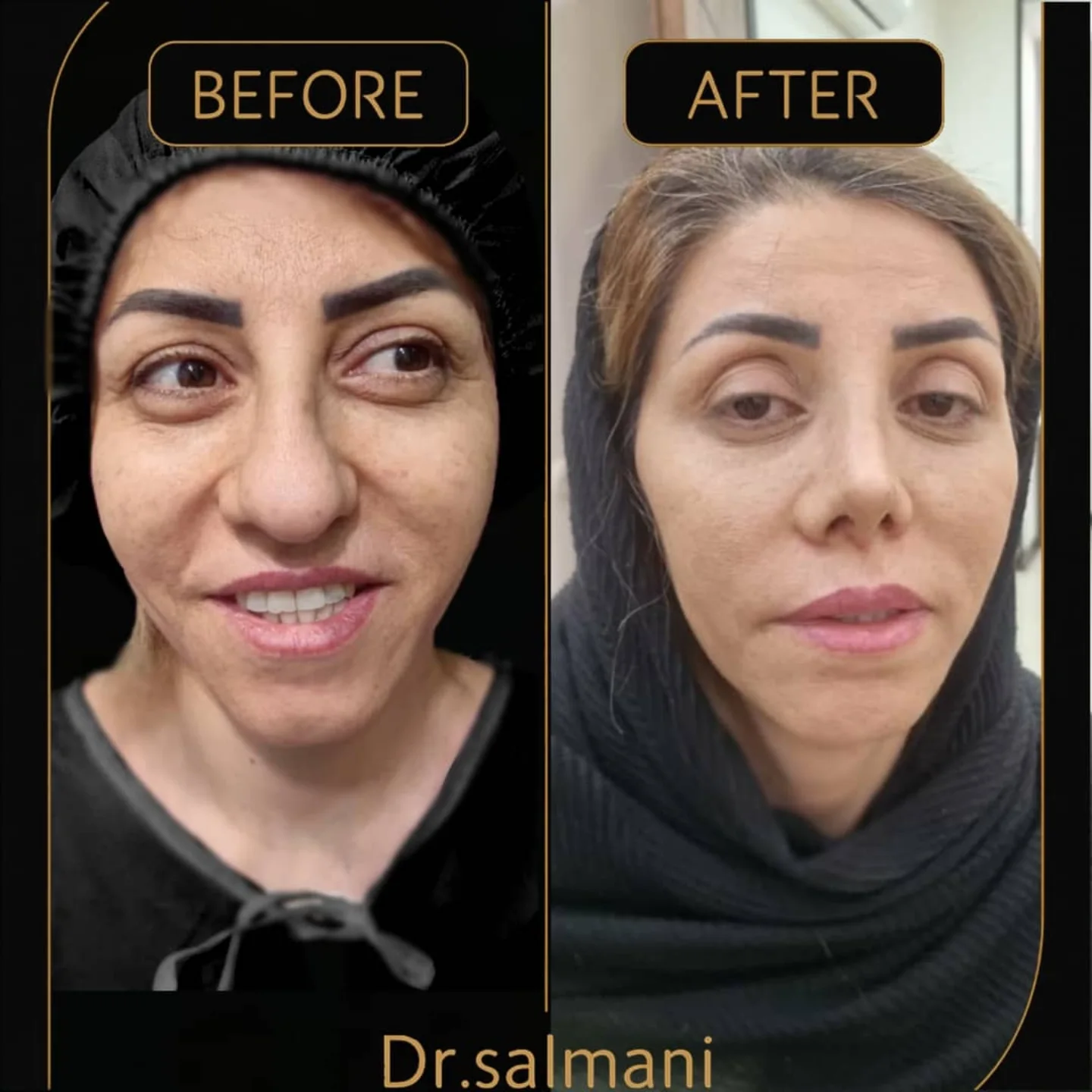 نمونه قبل و بعد جراحی بینی دکتر امیر سلمانی