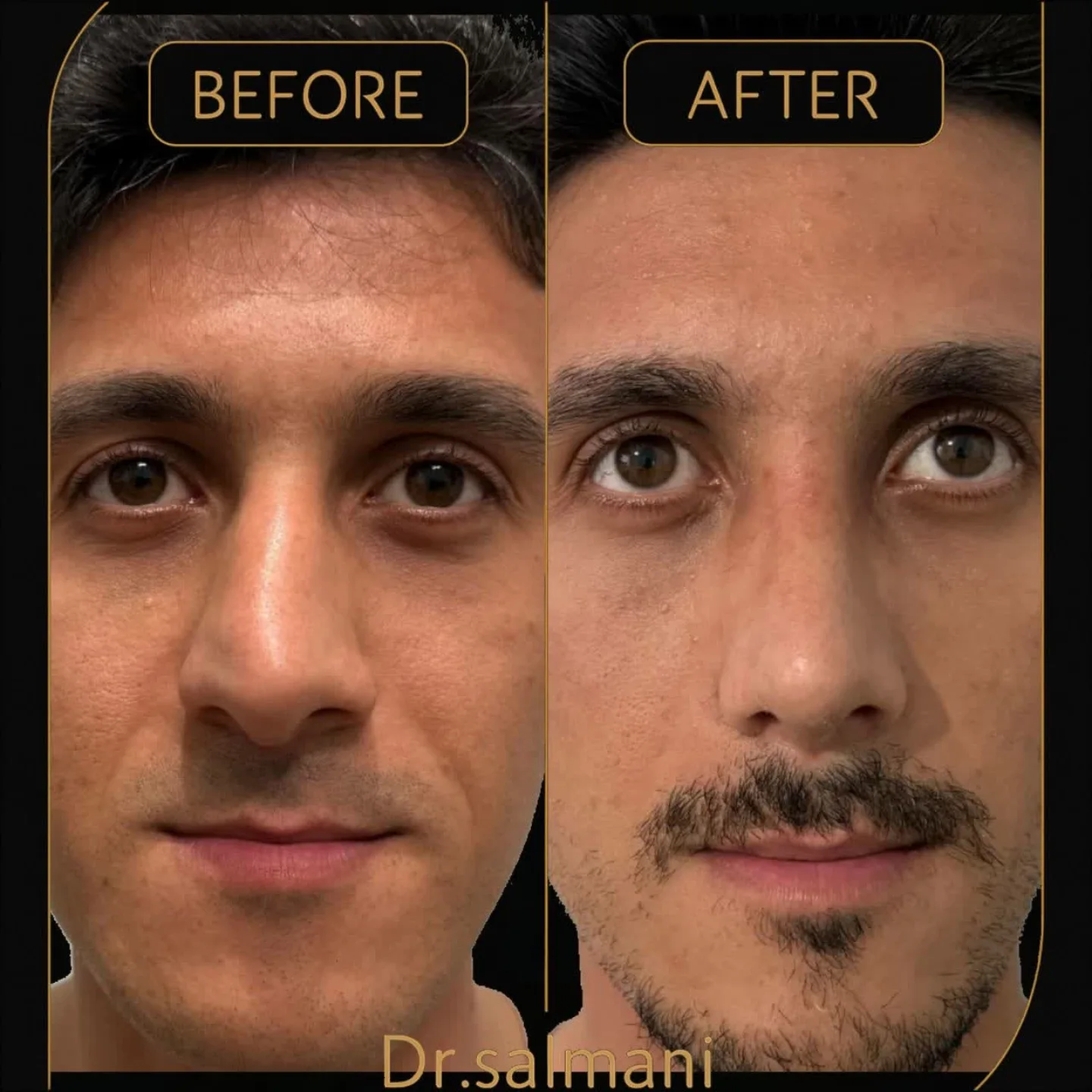 نمونه قبل و بعد جراحی بینی دکتر امیر سلمانی