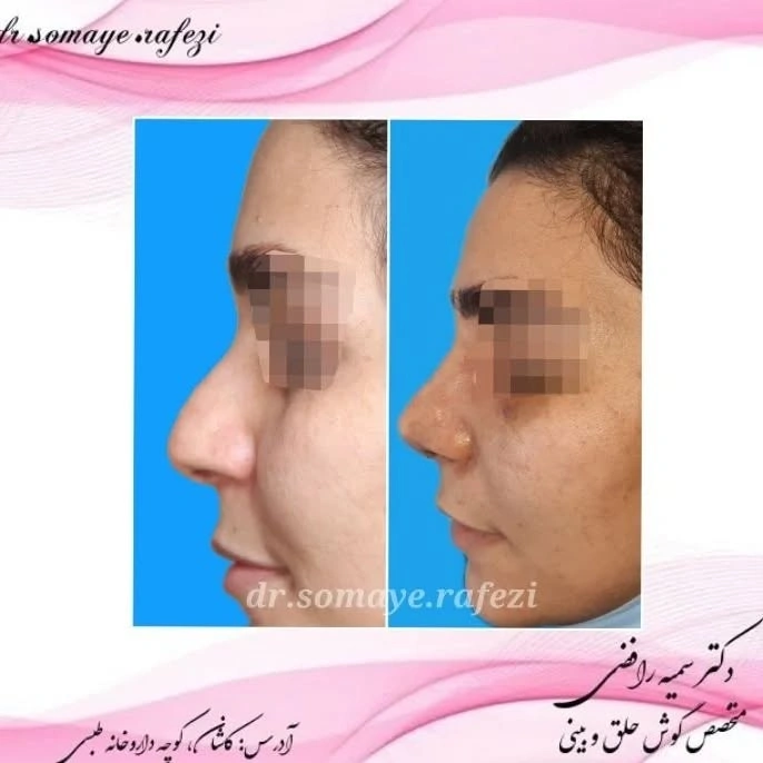 نمونه قبل و بعد جراحی بینی دکتر سمیه رافضی