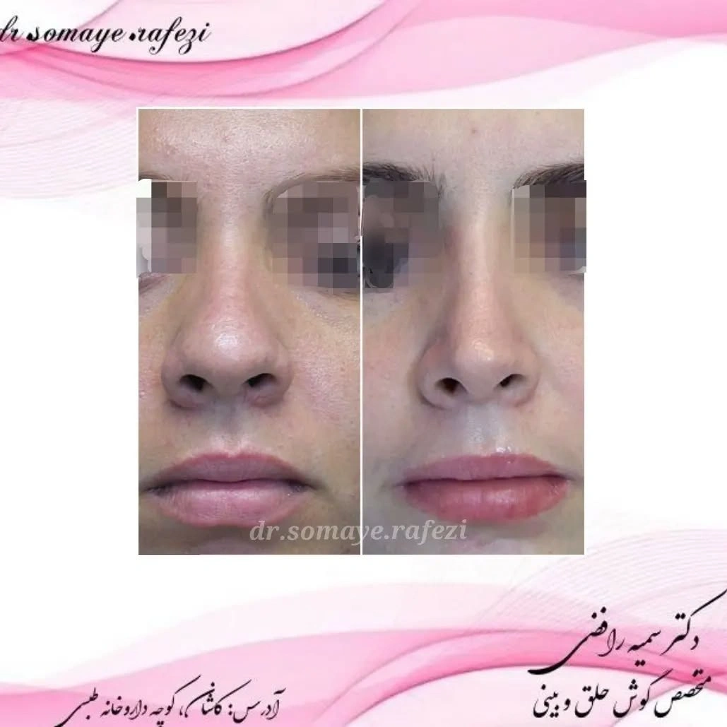 نمونه قبل و بعد جراحی بینی دکتر سمیه رافضی