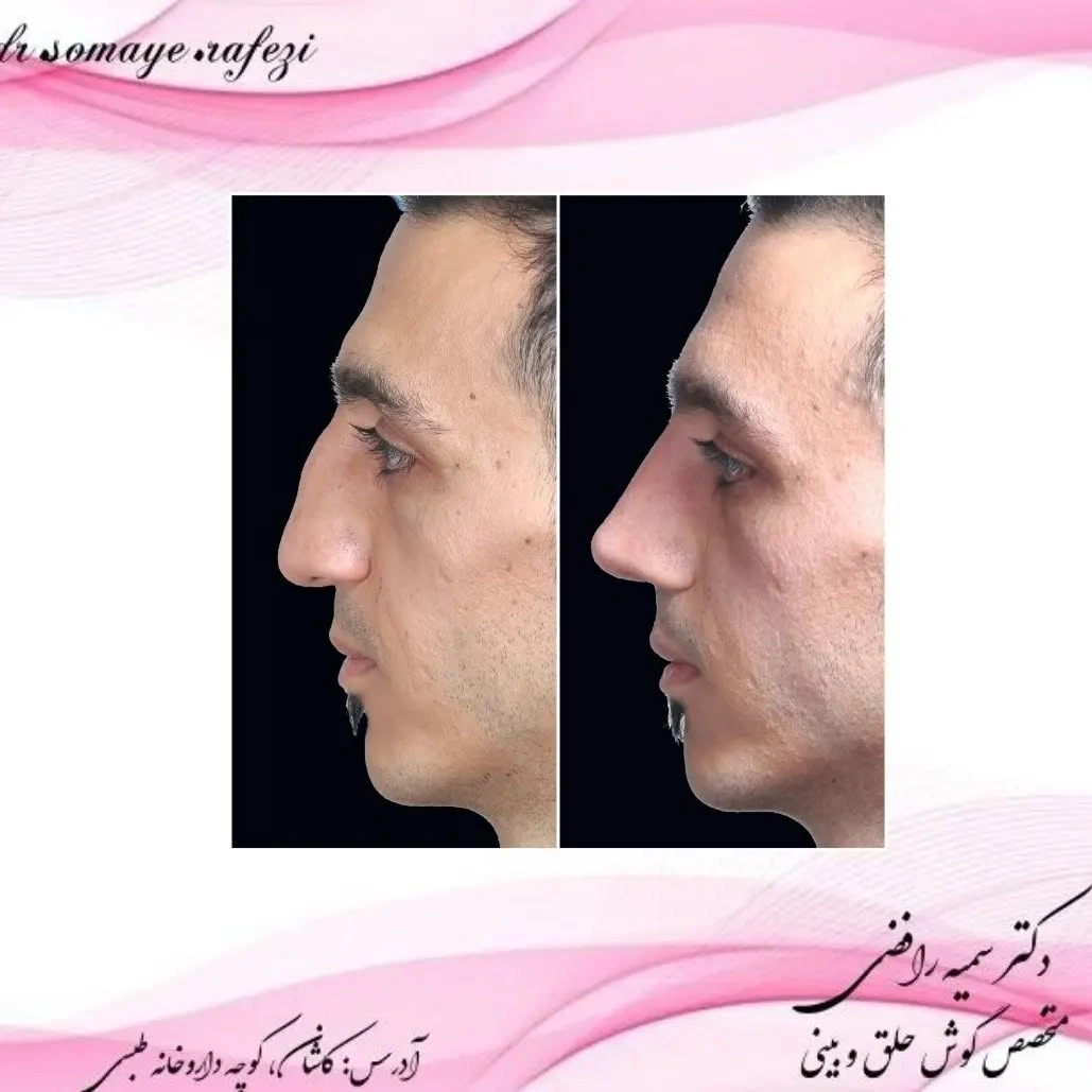 نمونه قبل و بعد جراحی بینی دکتر سمیه رافضی